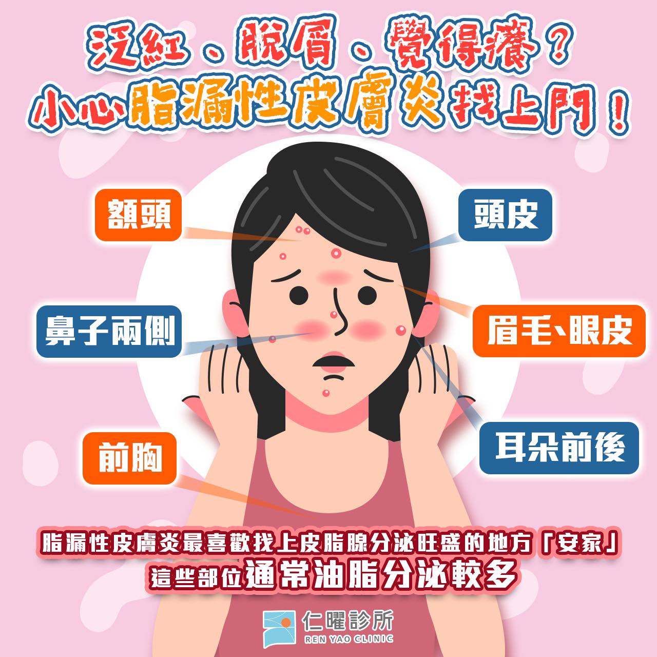 泛紅脫屑覺得癢？小心脂漏性皮膚炎找上門！